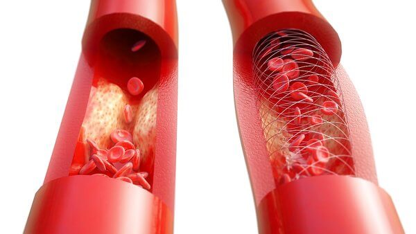 Grafik Arteriosklerose Arteriosklerose