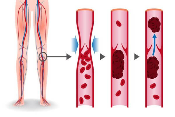 Grafik Thrombose Vitamin k und Thrombose